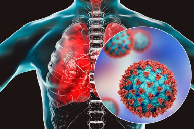 İnsan ciğerlerindeki SARS-CoV-2 virüsleri COVID-19 'a neden oluyor. Roman Coronavirus enfeksiyonu, 3 boyutlu illüstrasyon