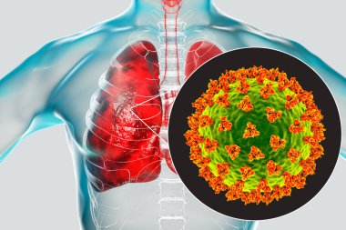 İnsan ciğerlerindeki SARS-CoV-2 virüsleri COVID-19 'a neden oluyor. Roman Coronavirus enfeksiyonu, 3 boyutlu illüstrasyon