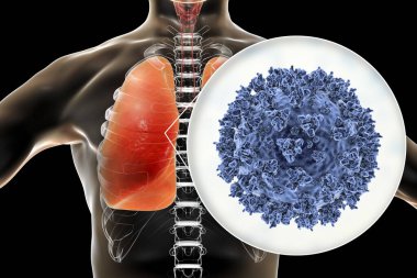 İnsan ciğerlerindeki SARS-CoV-2 virüsleri COVID-19 'a neden oluyor. Roman Coronavirus enfeksiyonu, 3 boyutlu illüstrasyon