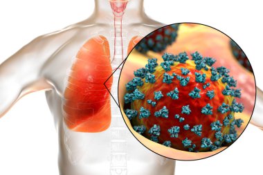 İnsan ciğerlerindeki SARS-CoV-2 virüsleri COVID-19 'a neden oluyor. Roman Coronavirus enfeksiyonu, 3 boyutlu illüstrasyon
