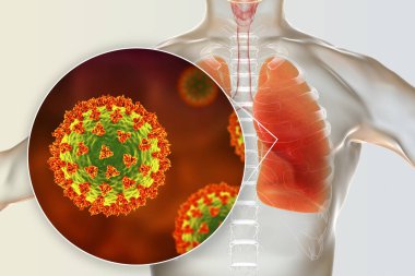 İnsan ciğerlerindeki SARS-CoV-2 virüsleri COVID-19 'a neden oluyor. Roman Coronavirus enfeksiyonu, 3 boyutlu illüstrasyon