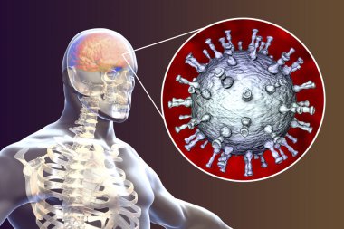 Varicella zoster virüsü VZV ensefaliti, tıbbi konsept, beyin enfeksiyonunu gösteren 3 boyutlu illüstrasyon ve beyindeki VZV 'nin yakın plan görüntüsü. Ensefalit suçiçeğinin komplikasyonlarından biridir.