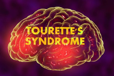 Tourette sendromu, tıbbi konsept, 3 boyutlu illüstrasyon. Sinir hastalıkları spektrumu ile karakterize edilen bir nöropsikiyatrik bozukluk.