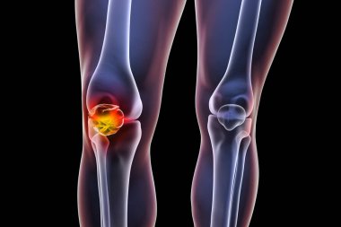 Patella multifragmente fraktür, 3D illüstrasyon gösteriyor ki diz kapağı parçacıkları yanlış hizalanmış, diz dengesi ve fonksiyon bozukluğu.