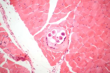 Kas dokusunda trichinella spiralis larvası, ansiklopedik parazitleri gösteren fotomikrograf. Trişinoz 'a neden olur, az pişmiş etten kaynaklanan parazit bir enfeksiyon..