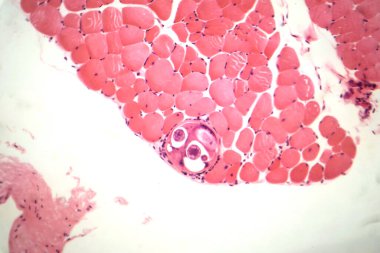 Kas dokusunda trichinella spiralis larvası, ansiklopedik parazitleri gösteren fotomikrograf. Trişinoz 'a neden olur, az pişmiş etten kaynaklanan parazit bir enfeksiyon..