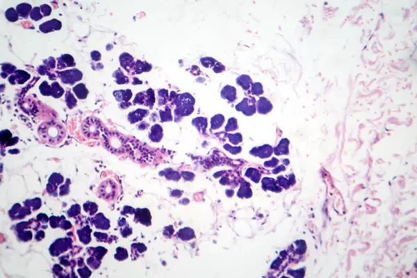 Karışık parotid tümör, epitel ve miyoepitel hücre bileşenlerini pleomorfik adenomda gösteren fotograf..
