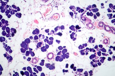 Karışık parotid tümör, epitel ve miyoepitel hücre bileşenlerini pleomorfik adenomda gösteren fotograf..