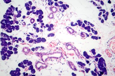 Karışık parotid tümör, epitel ve miyoepitel hücre bileşenlerini pleomorfik adenomda gösteren fotograf..
