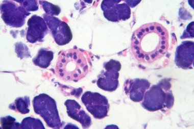 Karışık parotid tümör, epitel ve miyoepitel hücre bileşenlerini pleomorfik adenomda gösteren fotograf..