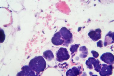 Karışık parotid tümör, epitel ve miyoepitel hücre bileşenlerini pleomorfik adenomda gösteren fotograf..