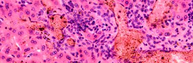 Karaciğerde coccidia, karaciğer içi parazitin hepatik koksidiyoza ve hepatosel hasara yol açtığını gösteren fotomikroskop..