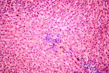 Karaciğerde coccidia, karaciğer içi parazitin hepatik koksidiyoza ve hepatosel hasara yol açtığını gösteren fotomikroskop..