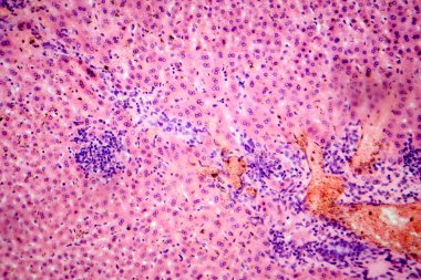 Karaciğerde coccidia, karaciğer içi parazitin hepatik koksidiyoza ve hepatosel hasara yol açtığını gösteren fotomikroskop..