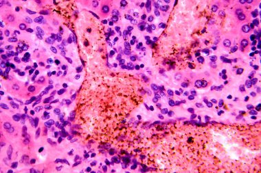 Karaciğerde coccidia, karaciğer içi parazitin hepatik koksidiyoza ve hepatosel hasara yol açtığını gösteren fotomikroskop..