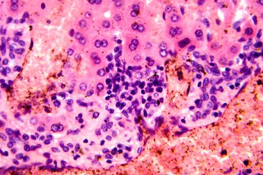 Karaciğerde coccidia, karaciğer içi parazitin hepatik koksidiyoza ve hepatosel hasara yol açtığını gösteren fotomikroskop..