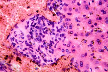 Karaciğerde coccidia, karaciğer içi parazitin hepatik koksidiyoza ve hepatosel hasara yol açtığını gösteren fotomikroskop..