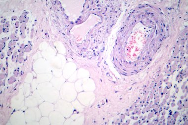 İskelet kas körelmesi, fotomikroskop aralarındaki boşlukta azalma olduğunu gösteriyor, miyofibrillerde azalma, yağ sızmasıyla endomyal bağ dokusunda artış..