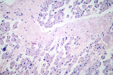 İskelet kas körelmesi, fotomikroskop aralarındaki boşlukta azalma olduğunu gösteriyor, miyofibrillerde azalma, yağ sızmasıyla endomyal bağ dokusunda artış..