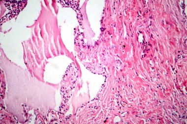 Lobar zatürreenin kırmızı hepatizasyon aşaması, kırmızı hücreler, nötrofiller ve fibrin ipliklerle alveolar fışkırma gösteren fotomikrograf..