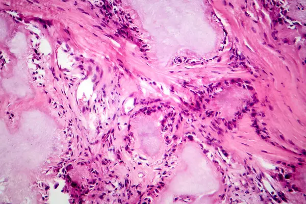 Gut tofusu, foto mikro fotograf yabancı cisim dev hücre tepkimesi ve iltihaplanması ile şekilsiz, eozinofik materyal gösteriyor..