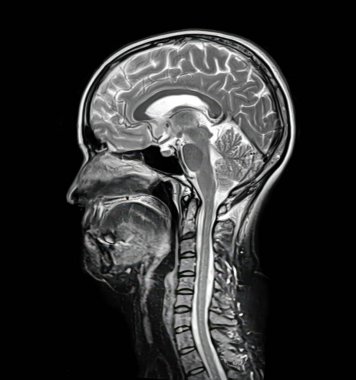 44 yaşındaki bir hastanın beyin ve boyun röntgenleri (MRI) merkezi sinir sistemi anatomisi ve boyun omurgasını gösteriyor..