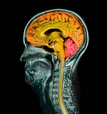 44 yaşındaki bir hastaya ait beyin görüntüsü (MRI), turuncu ve omurilik ile işaretlenmiş, kırmızı beyincik (beyincik) ile renklendirilmiş..