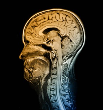 44 yaşındaki bir hastaya ait beyin ve boyun taraması (MRI), merkezi sinir sistemi anatomisini ve boyun omurgasını gösteriyor..