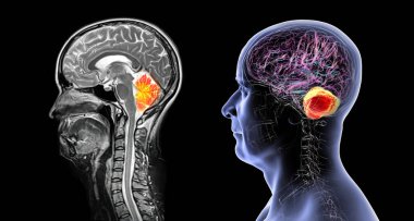 Beyincik, 3 boyutlu illüstrasyon ve renkli MRI kompozit görüntü, beyin anatomisini vurgulanmış beyincik ile gösteriyor, koordinasyon, denge ve motor kontrol için önemli.