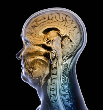 Renkli kompozit manyetik rezonans görüntüleme (MRI) taraması ve 44 yaşındaki bir hastanın beyin ve boynunun 3 boyutlu çizimi, merkezi sinir sistemi anatomisini ve boyun omurgasını gösteriyor..