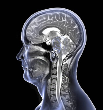 44 yaşındaki bir hastanın beyin ve boynundaki birleşik manyetik rezonans görüntüleme (MRI) taraması ve 3 boyutlu resimleme merkezi sinir sistemi anatomisini ve rahim omurgasını gösteriyor..
