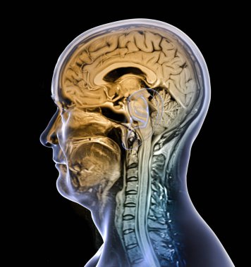 Renkli kompozit manyetik rezonans görüntüleme (MRI) taraması ve 44 yaşındaki bir hastanın beyin ve boynunun 3 boyutlu çizimi, merkezi sinir sistemi anatomisini ve boyun omurgasını gösteriyor..