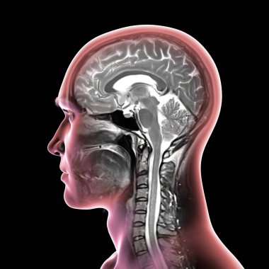 44 yaşındaki bir hastanın beyin ve boynundaki birleşik manyetik rezonans görüntüleme (MRI) taraması ve 3 boyutlu resimleme merkezi sinir sistemi anatomisini ve rahim omurgasını gösteriyor..