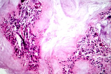 Gut tofusu, foto mikro fotograf yabancı cisim dev hücre tepkimesi ve iltihaplanması ile şekilsiz, eozinofik materyal gösteriyor..