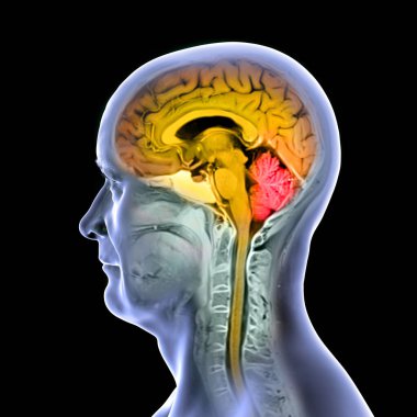 Renkli kompozit MRI görüntüsü ve 44 yaşındaki bir hastanın beyin ve omuriliği turuncu ve kırmızı beyincik ile işaretlenmiş üç boyutlu çizimi..