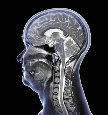 44 yaşındaki bir hastanın beyin ve boynundaki birleşik manyetik rezonans görüntüleme (MRI) taraması ve 3 boyutlu resimleme merkezi sinir sistemi anatomisini ve rahim omurgasını gösteriyor..
