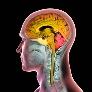 Renkli kompozit MRI görüntüsü ve 44 yaşındaki bir hastanın beyin ve omuriliği turuncu ve kırmızı beyincik ile işaretlenmiş üç boyutlu çizimi..