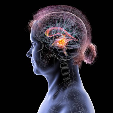 Beyin tümörünün serebral su kemerine baskı yapması sonucu oluşan genişlemiş lateral ve üçüncü ventriküller (hidrosefalus)..