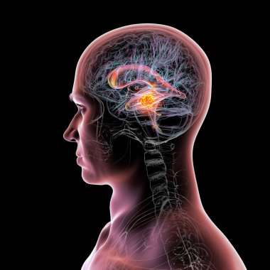 Beyin tümörünün serebral su kemerine baskı yapması sonucu oluşan genişlemiş lateral ve üçüncü ventriküller (hidrosefalus)..