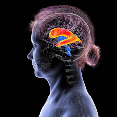 Beynin genişlemiş yanal ventrikülleri (hidrosefali), 3 boyutlu illüstrasyon.