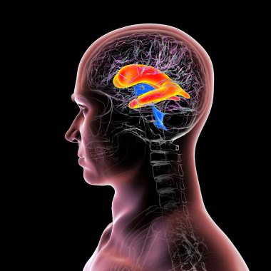 Beynin genişlemiş yanal ventrikülleri (hidrosefali), 3 boyutlu illüstrasyon.