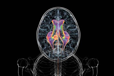 Beyin tümörünün serebral su kemerine baskı yapması sonucu oluşan genişlemiş lateral ve üçüncü ventriküller (hidrosefalus). Üst görünüm.