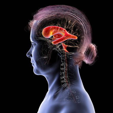 Normal basınçlı hidrosefali olan insan beyni, genişlemiş ventriküller ve beyin dokusu sıkışması gösteren 3 boyutlu çizimler..