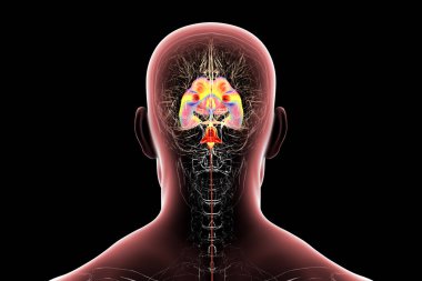 Normal basınçlı hidrosefali olan insan beyni, genişlemiş ventriküller ve beyin dokusu sıkışması gösteren 3 boyutlu çizimler..