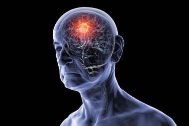 Beyin tümörü, yaşlı bir insanda insan beyninin 3 boyutlu çizimi, tümör kütlesini vurguluyor ve beyin fonksiyonları ve yaşla ilgili nörolojik patoloji üzerindeki etkisini vurguluyor..