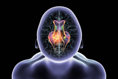 Beyin tümörünün serebral su kemerine baskı yapması sonucu oluşan genişlemiş lateral ve üçüncü ventriküller (hidrosefalus)..