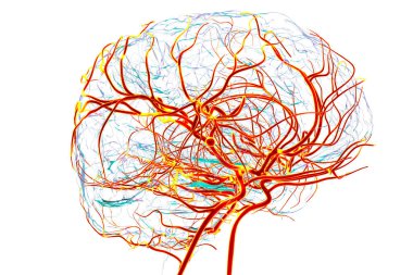 Beynin orta serebral arterinde Sacküler anevrizma, vasküler patoloji ve felç riskini vurgulayan üç boyutlu illüstrasyon.