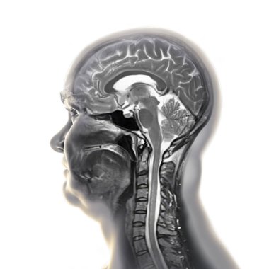 Beynin ve boynun renkli manyetik rezonans görüntüleme (MRI) taraması, merkezi sinir sistemi anatomisi ve servikal omurgayı gösteren 3D illüstrasyon.