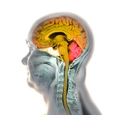 Beynin ve boynun renkli manyetik rezonans görüntüleme (MRI) taraması, merkezi sinir sistemi anatomisi ve servikal omurgayı gösteren 3 boyutlu illüstrasyon. Beyin ve omurilik turuncu ve beyincik kırmızıyla vurgulanır..