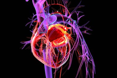 Sol atriyum kırmızıyla işaretlenmiş, 3 boyutlu çizim. Sol atriyum pulmoner damarlardan oksijenli kan alır, genişleme mitral kapakçık hastalığı ve atriyal fibrilasyonla ilişkilidir. Sol görünüm.